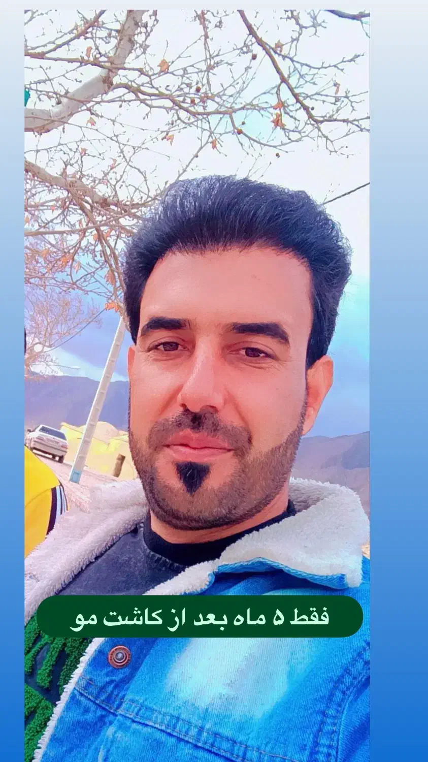 کاشت مو توسط تکنسین شیرازی در یزد|خدمات آرایشگری و زیبایی|یزد, |دیوار