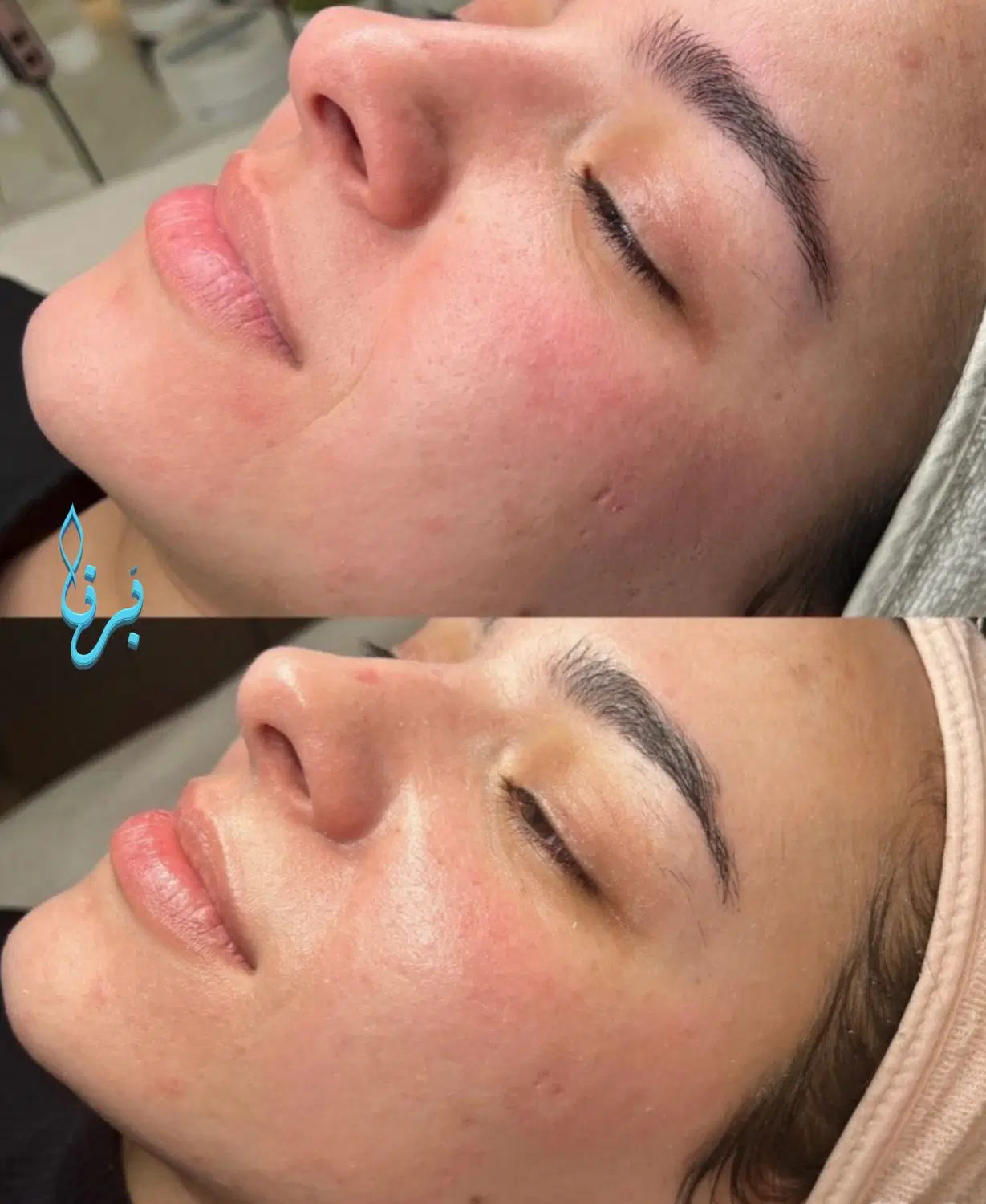 جای جوش و لک رو به پوست صافتر تبدیل کن|خدمات زیبایی و سلامت|اصفهان, وحید|دیوار