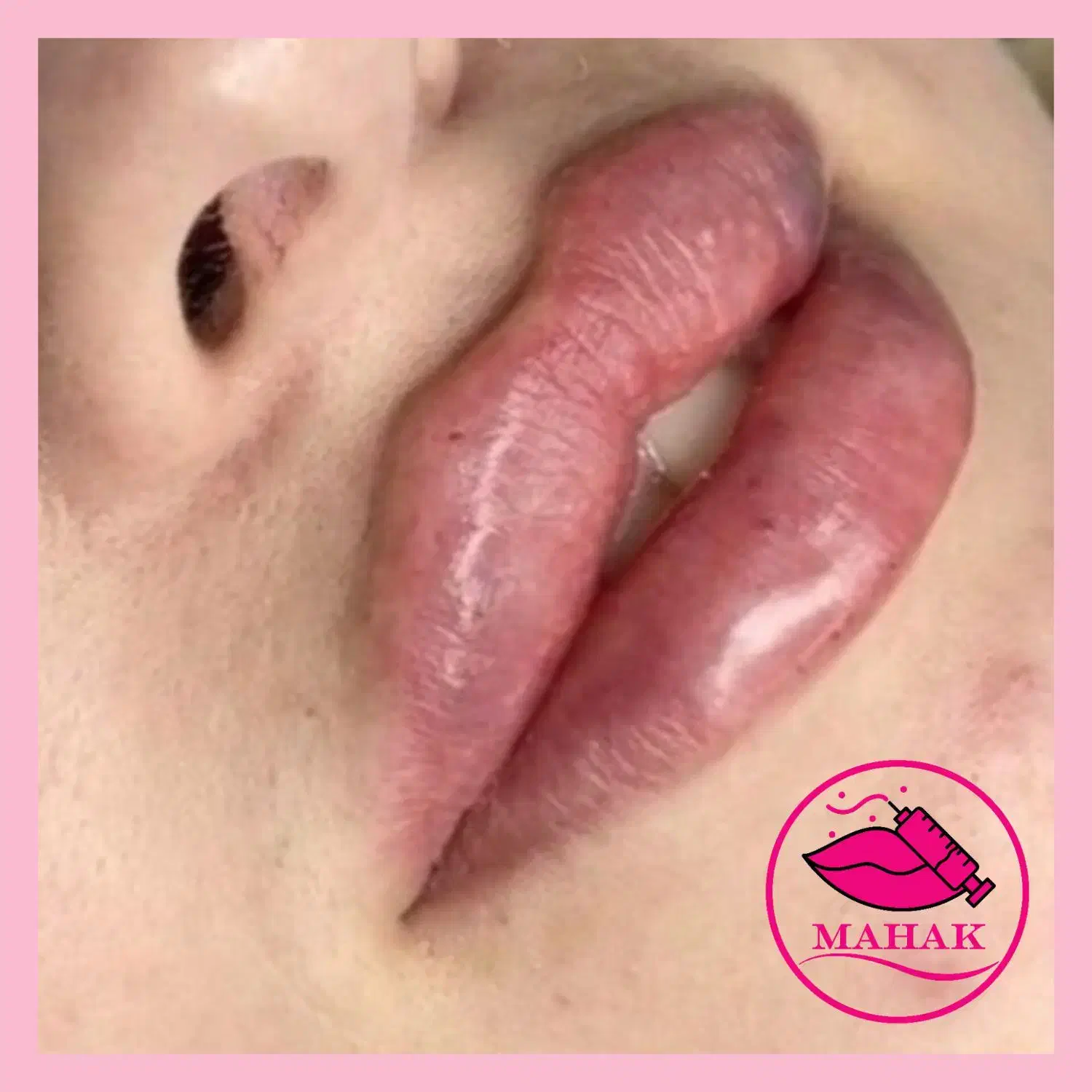 آموزش ژل فیلربوتاکس پرسینگ شیدینگ لب|خدمات آموزشی|قم, شهرک قدس|دیوار