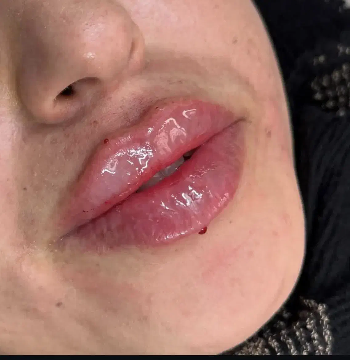 اف تزریق ژل روسی،عربی،خلیجی، بوتاکس|خدمات آرایشگری و زیبایی|شیراز, شهرک امیر کبیر|دیوار