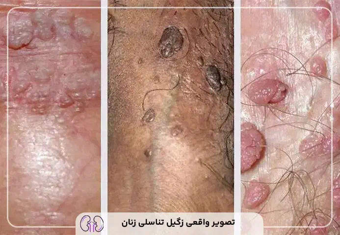 پک درمان زگیل تناسلی کاملا گیاهی و صددرصد تضمینی|آرایشی، بهداشتی، درمانی|کرمانشاه, |دیوار