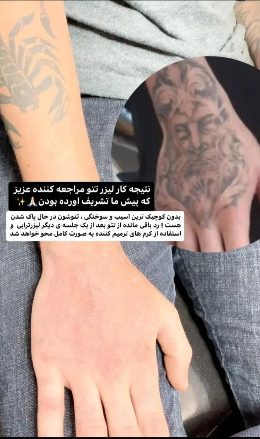 کربن تراپی لیزر کیوسوئیچ بستن منافذ|خدمات آرایشگری و زیبایی|دهدشت, |دیوار