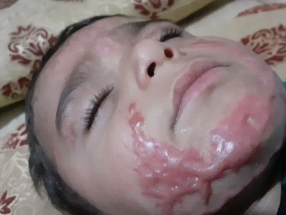 مشاوره درموردسوختگی کودکان|فعالیت داوطلبانه تحقیقاتی|قم, شهر قائم|دیوار