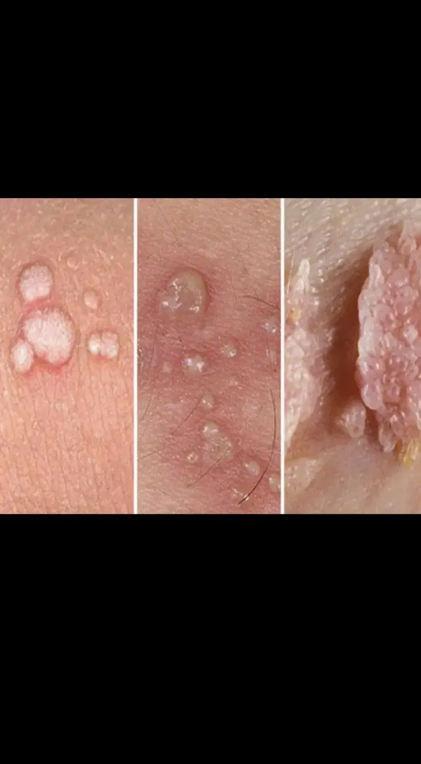 درمان ریشه ای و گیاهی HPV زگیل|آرایشی، بهداشتی، درمانی|اصفهان, هزارجریب|دیوار