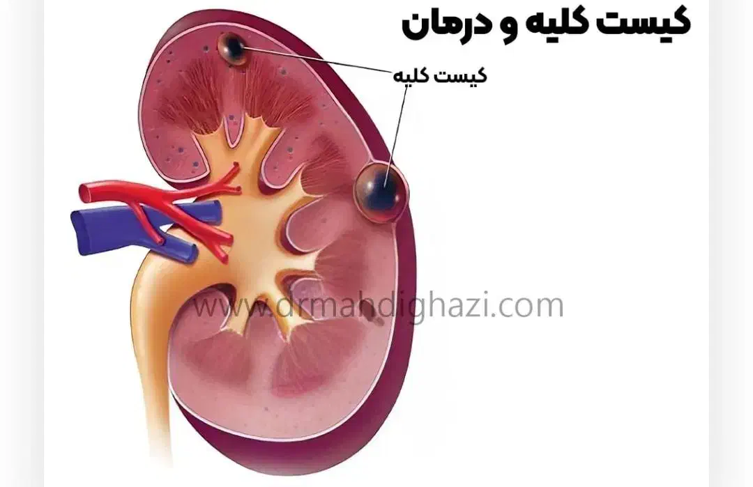 درمان سنگ کلیه|آرایشی، بهداشتی، درمانی|قم, جوی شور|دیوار
