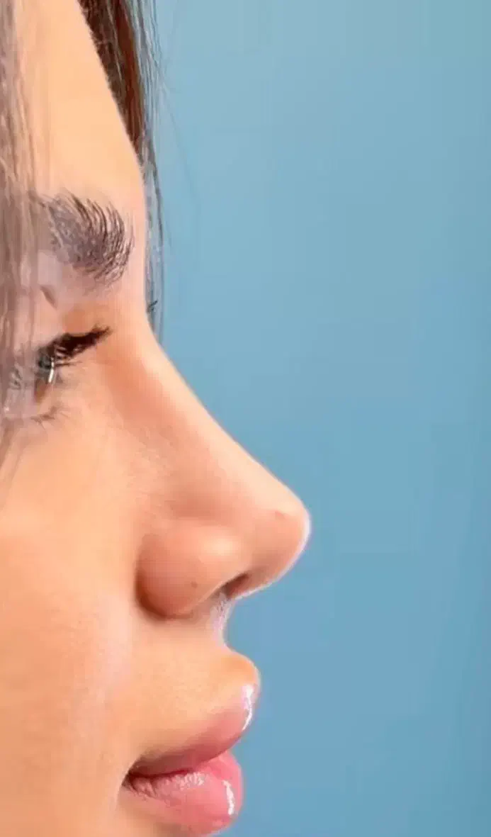 تخفیف عمل بینی،رفع غبغب لیپو،ابدو،لیفت،دایرکت ابرو|خدمات آرایشگری و زیبایی|آمل, |دیوار