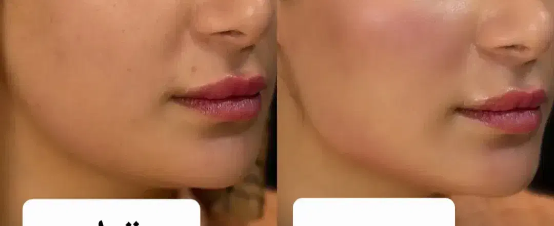 جذب مدل ژل صورت مخصوص فرمدهی و جوانسازی|خدمات آرایشگری و زیبایی|اندیمشک, |دیوار