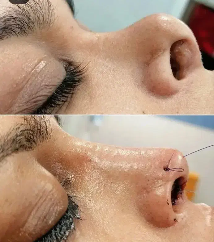 عمل بینی/پلک/غبغب/بوتاکس/پیکرتراشی|خدمات آرایشگری و زیبایی|یاسوج, |دیوار