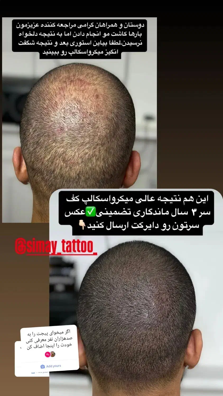 میکرو اسکالپ سر|خدمات آرایشگری و زیبایی|شیراز, اصلاح‌نژاد|دیوار