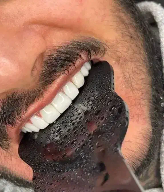 کامپوزیت دندان|خدمات آرایشگری و زیبایی|اردبیل, |دیوار