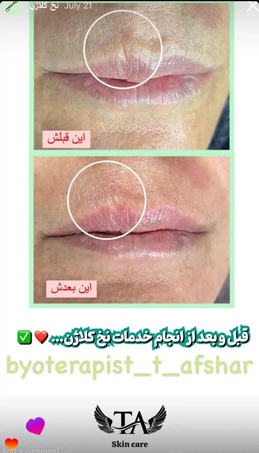 درمان حرفهای لک و ککومک و مزو تراپی|خدمات آرایشگری و زیبایی|برازجان, |دیوار