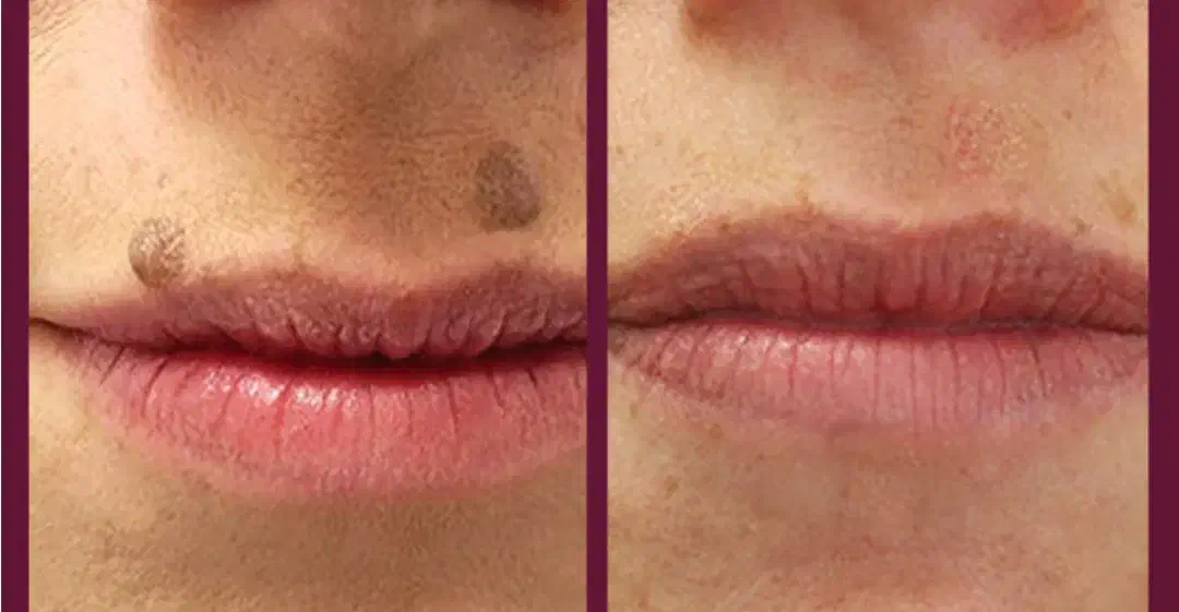 خال برداری ومزونیدلینگ وپلاسما|خدمات آرایشگری و زیبایی|قم, نیروگاه|دیوار