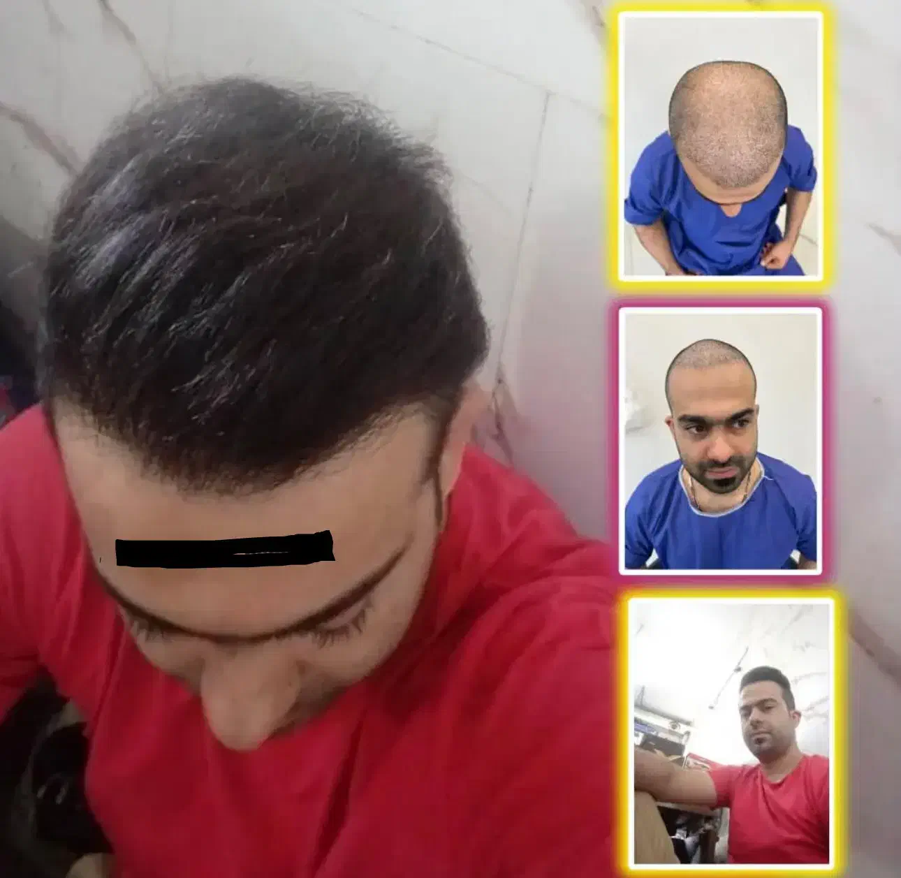 آفر ویژه کاشت مو و ابرو|خدمات آرایشگری و زیبایی|تهران, دبستان|دیوار