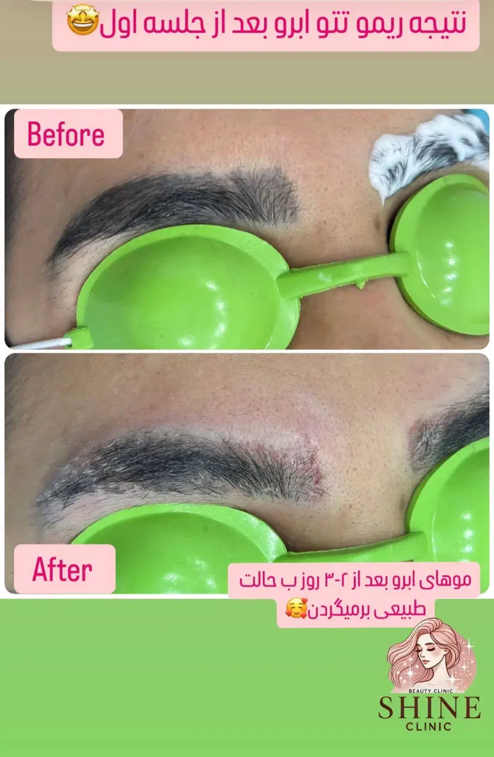 روشن سازی با لیزر پیکوشور و پاک کردن تتو|خدمات آرایشگری و زیبایی|هندیجان, |دیوار