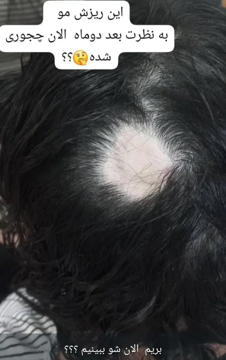 تونیک ضد ریزش و محرک رشد مجدد مو|آرایشی، بهداشتی، درمانی|بابل, |دیوار