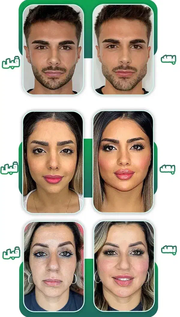 تخفیف ویژه تزریق فیلر لیبل دار با ماندگاری بالا|خدمات آرایشگری و زیبایی|تهران, زعفرانیه|دیوار