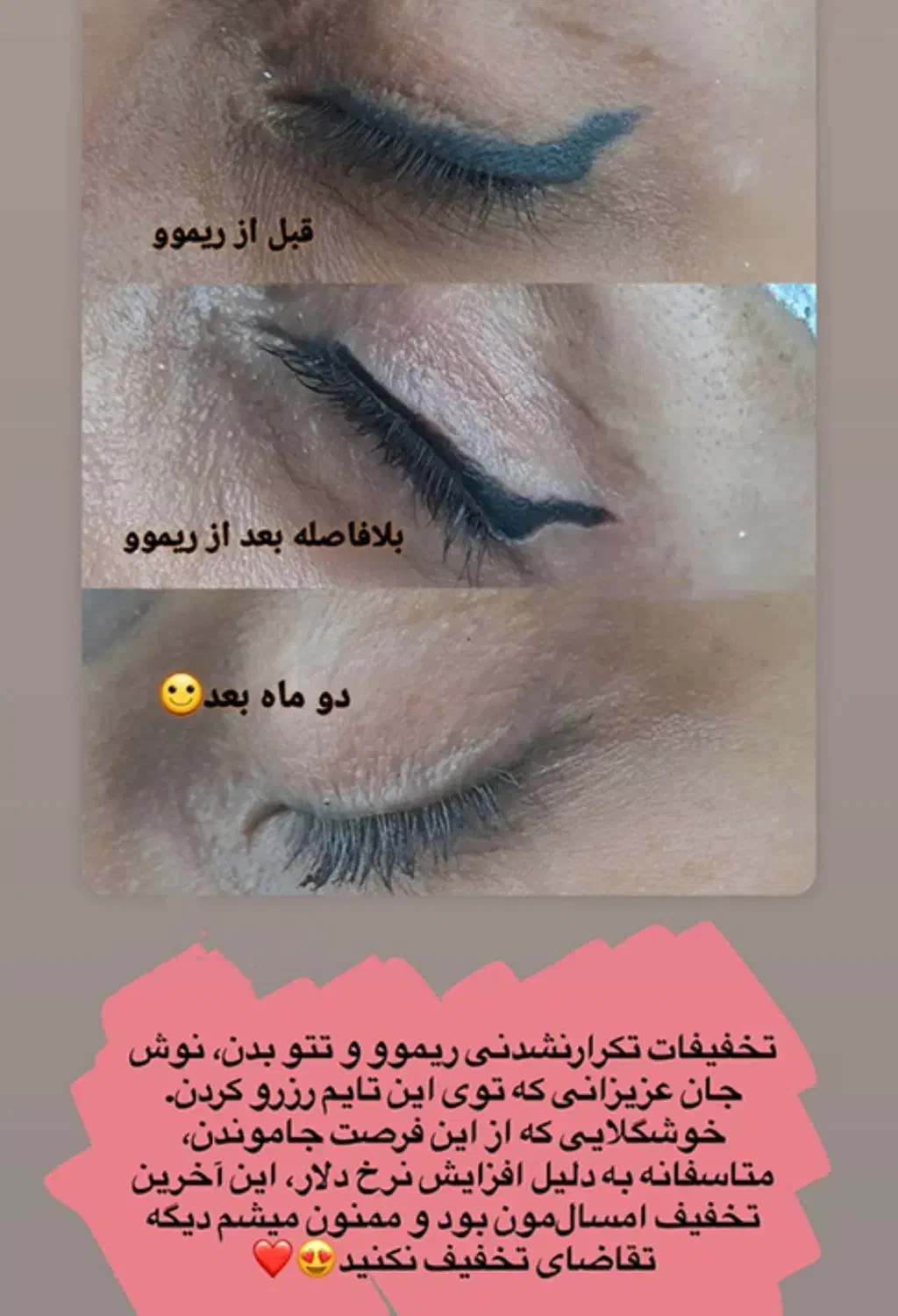 پاک کردن یا ریموو تک جلسه ای صورت و بدن|خدمات آرایشگری و زیبایی|آبدانان, |دیوار
