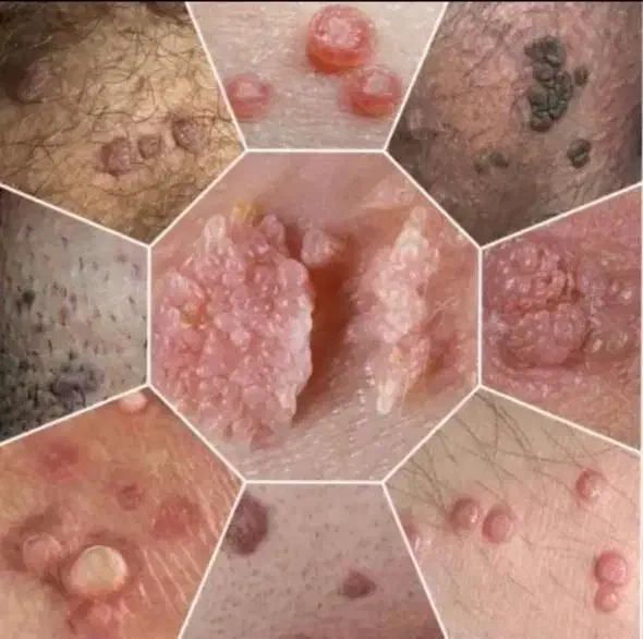 پک درمان زگیل تناسلی کاملا گیاهی و صددرصد تضمینی|آرایشی، بهداشتی، درمانی|کرمانشاه, |دیوار