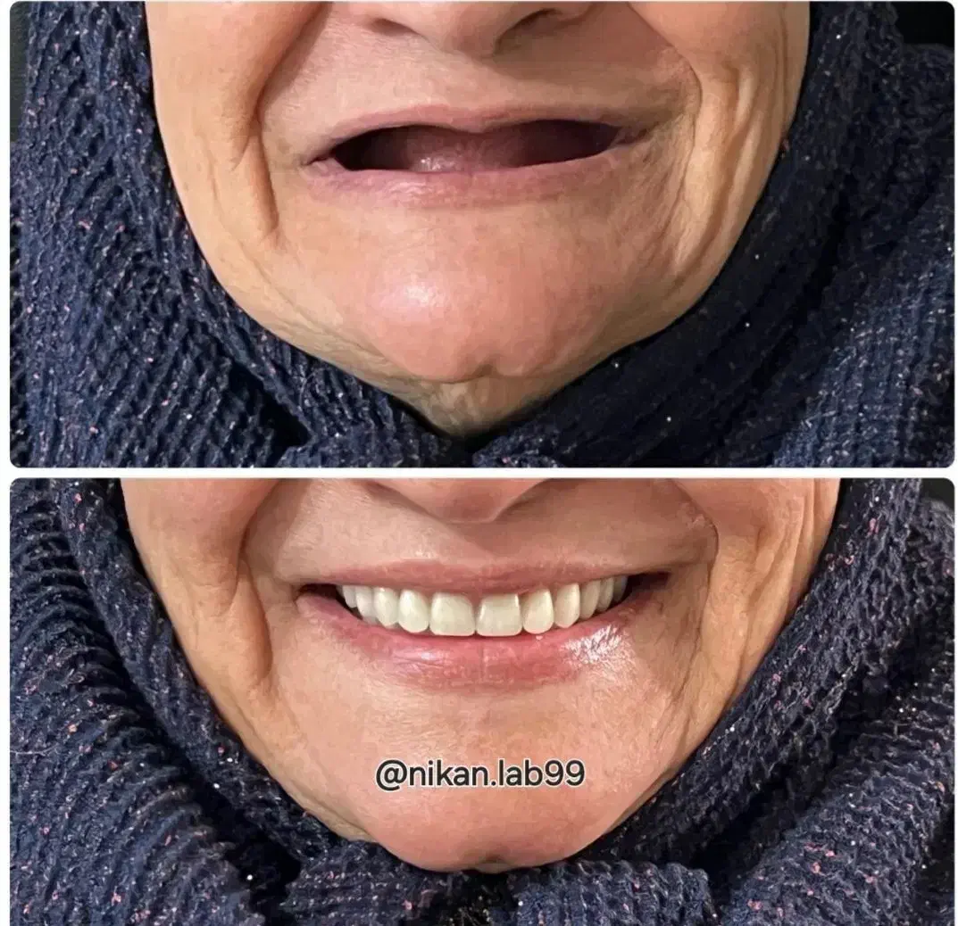 دندانسازی دندان مصنوعی تحویل ۲روزه باضمانت|خدمات آرایشگری و زیبایی|اصفهان, کشاورزی|دیوار