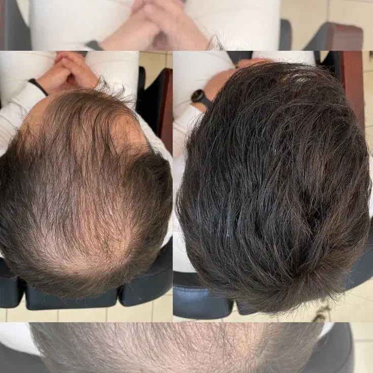 درمان قطعی ریزش مو و رویش مجدد|آرایشی، بهداشتی، درمانی|پارس‌آباد, |دیوار