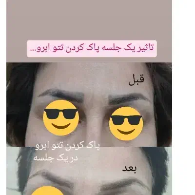 لیزر پاک کردن تتو ابرو و بدن و خالکوبی قدیمی|خدمات آرایشگری و زیبایی|اهواز, اهواز|دیوار