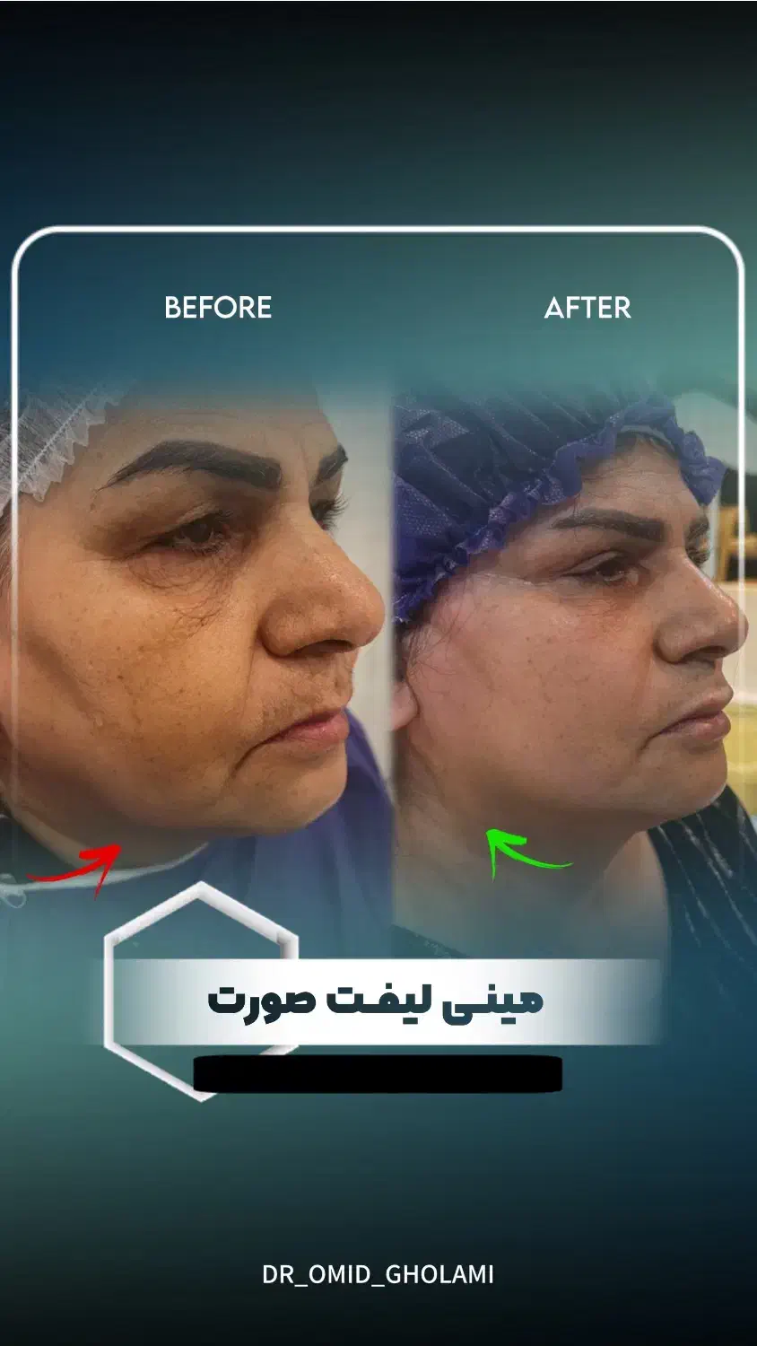 بلفارو/ لیفت صورت و ابرو/غبغب/تزریق چربی با تخفیف|خدمات آرایشگری و زیبایی|مشهد, سجاد شهر|دیوار