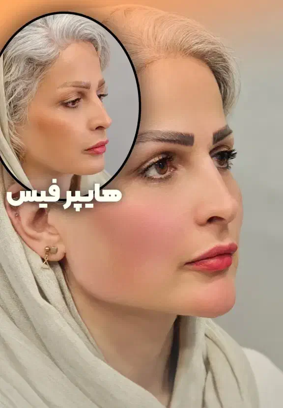 تزریق فیلر لب روسی|خدمات آرایشگری و زیبایی|تهران, ستارخان|دیوار