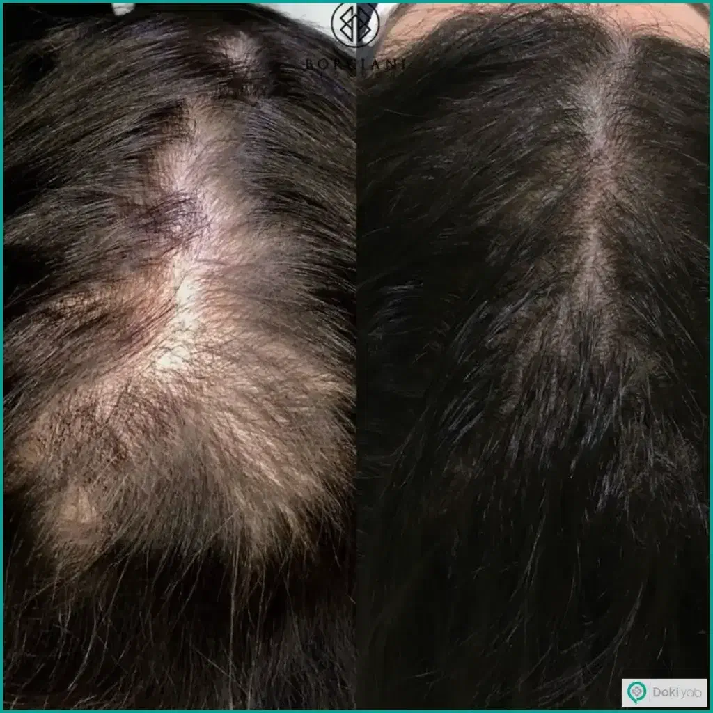 پی آر پی و مزوتراپی مو و ابرو|خدمات آرایشگری و زیبایی|اردبیل, |دیوار