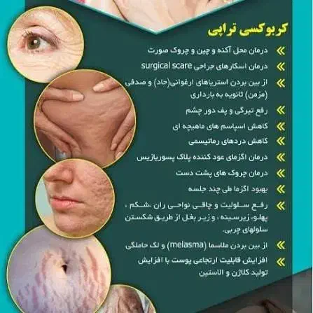 کربوکسی تراپی ویژه|خدمات آرایشگری و زیبایی|رفسنجان, |دیوار