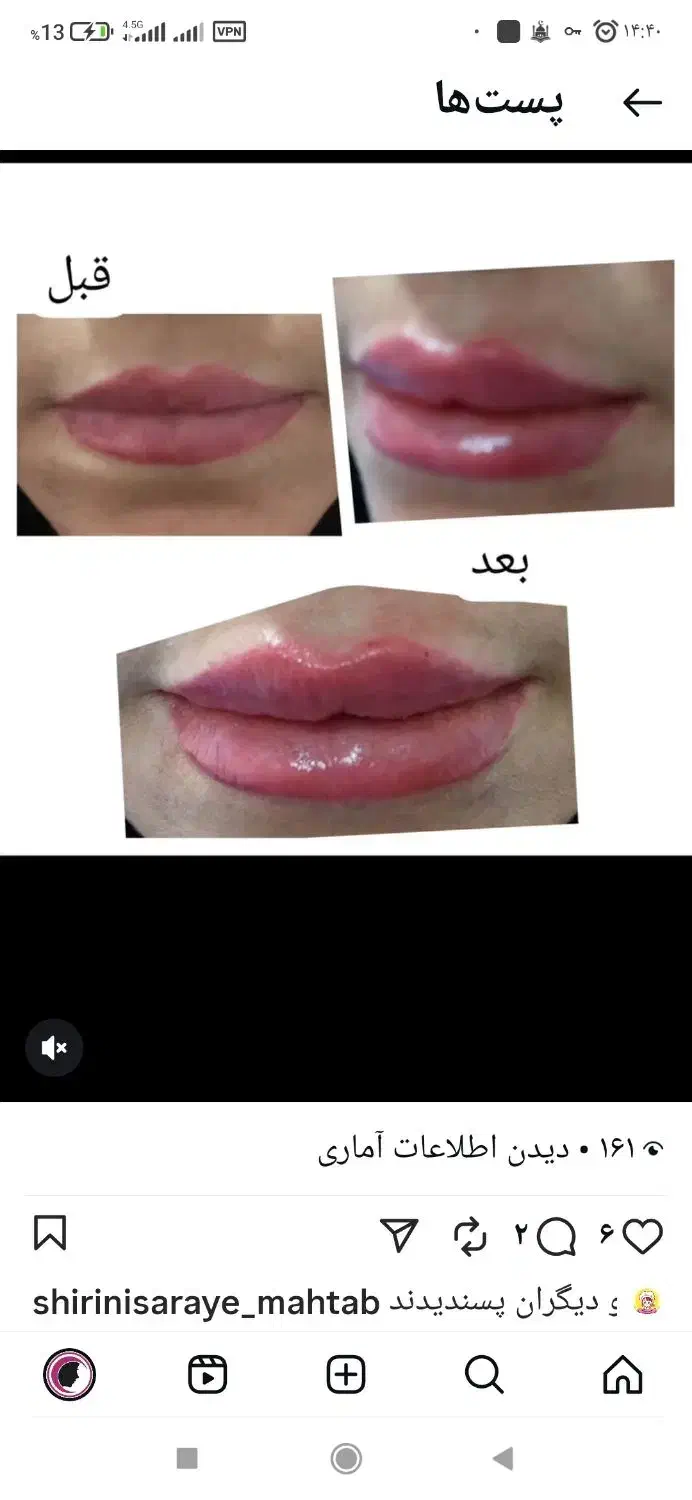 دوره آموزش ژل بوتاکس فیلر و زیبایی|خدمات آموزشی|امیدیه, |دیوار