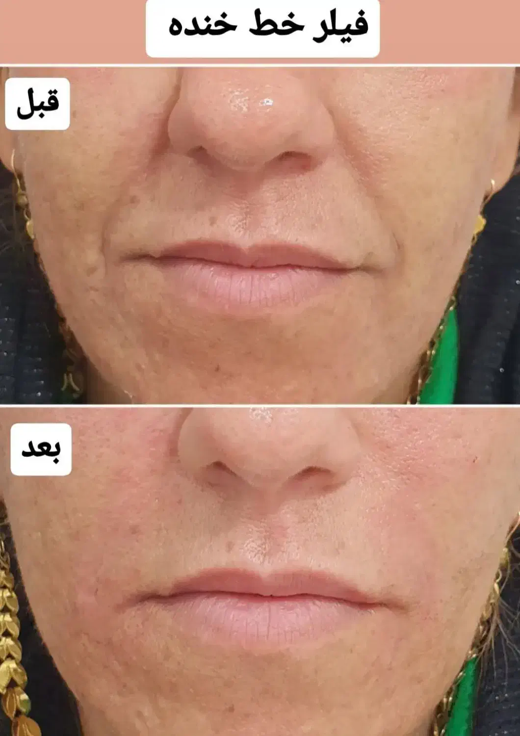 تزریق فیلر وبوتاکس وجوانساز صورت|خدمات آرایشگری و زیبایی|کارون, |دیوار