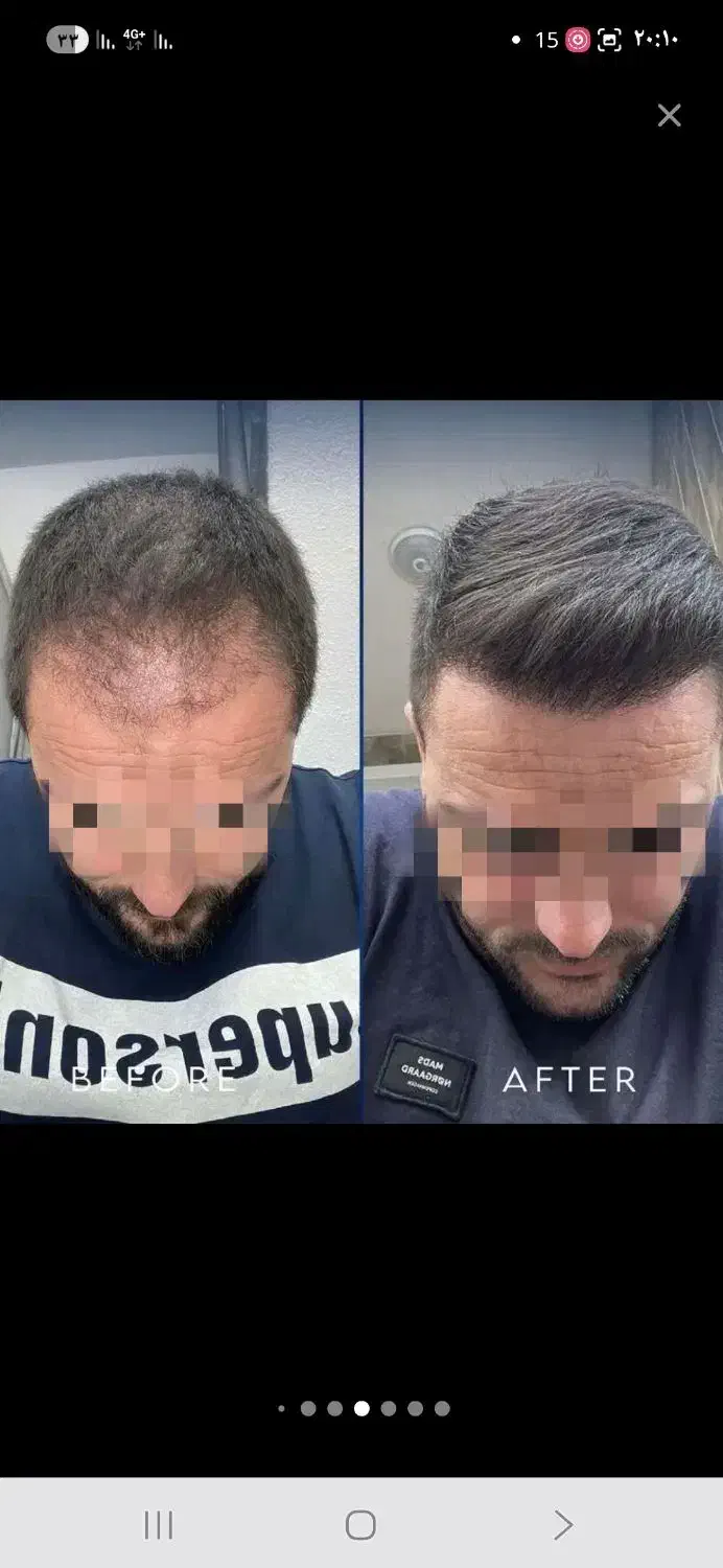 کاشت موی شیرازی|خدمات آرایشگری و زیبایی|مریوان, |دیوار