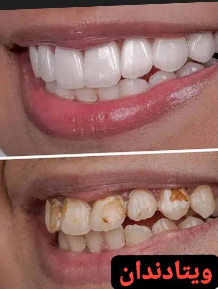 دندان سازی ویتا خدمات و ساخت دندان|پزشکی|بابل, |دیوار