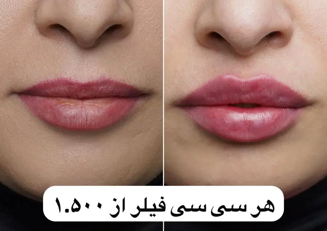 هایفو، فیلر، بوتاکس|خدمات آرایشگری و زیبایی|تهران, جیحون|دیوار