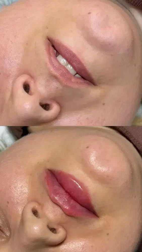 تزریق ژل و بوتاکس|خدمات آرایشگری و زیبایی|بابل, |دیوار