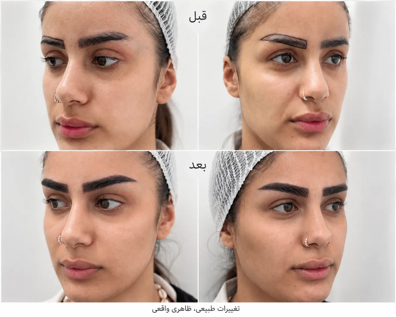 کاشت ابرو، تکمیل ظرفیت شهریور فقط ۱۰ تومان|خدمات زیبایی و سلامت|تهران, شاهین|دیوار