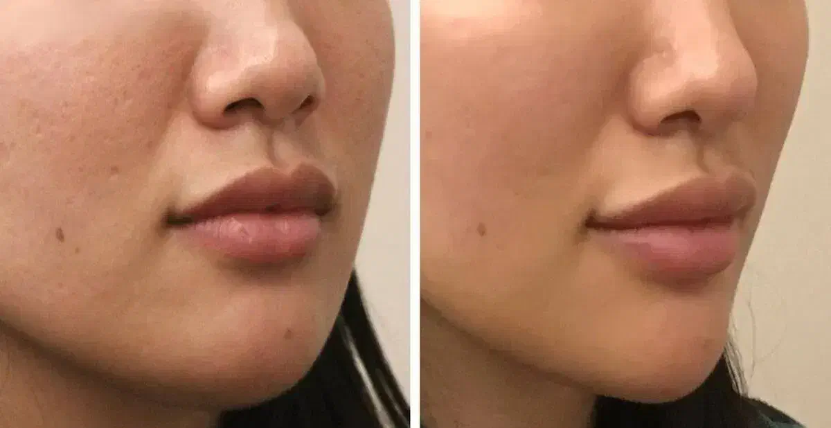 ژل بوتاکس آموزش تخصصی در مطب|خدمات آرایشگری و زیبایی|اصفهان, شهرک کاوه|دیوار