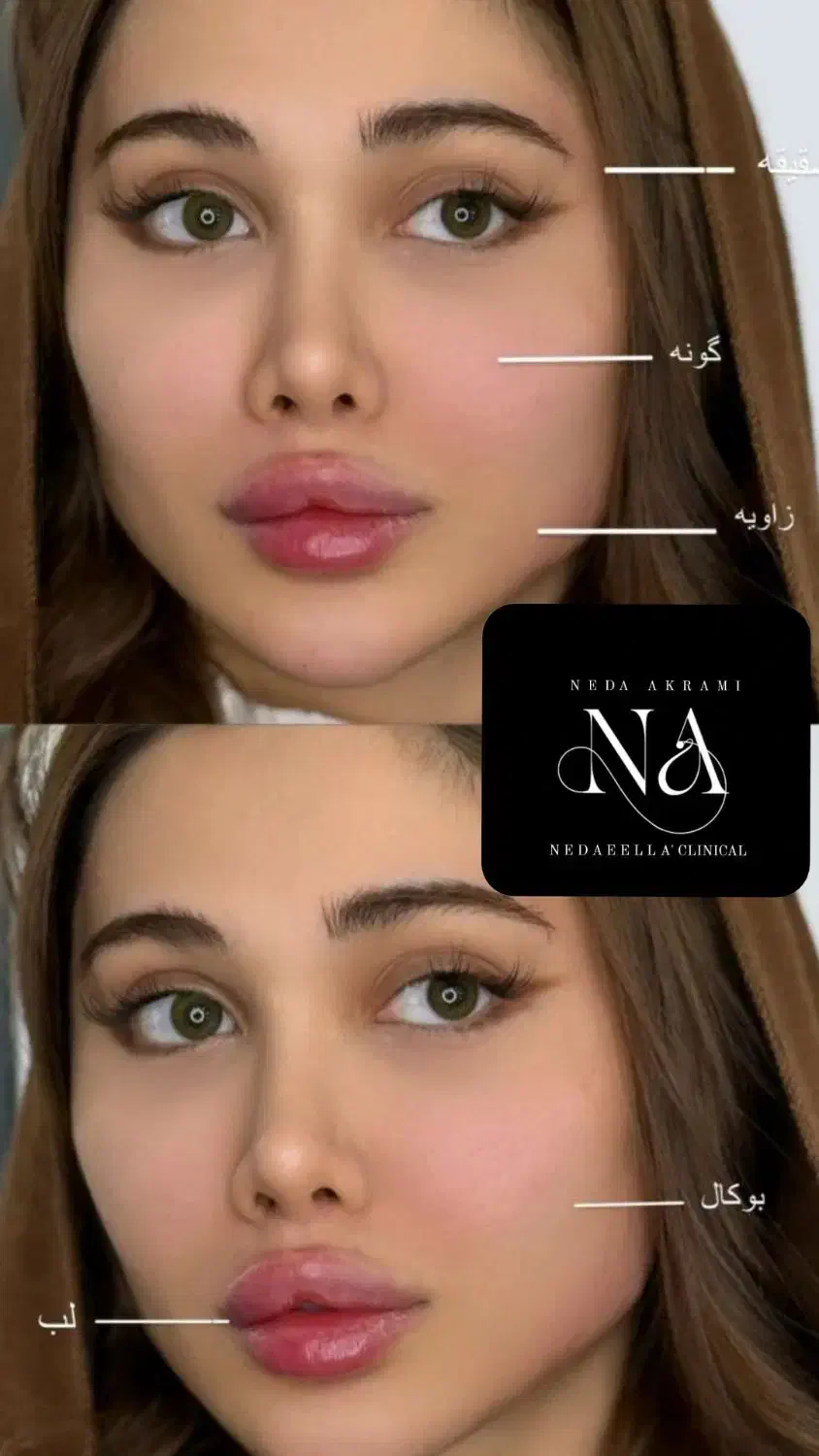 ژل لب و فول فیس ۳۷۰هزار تومان توسط پزشک کلینیک|خدمات آرایشگری و زیبایی|کرج, گوهردشت|دیوار