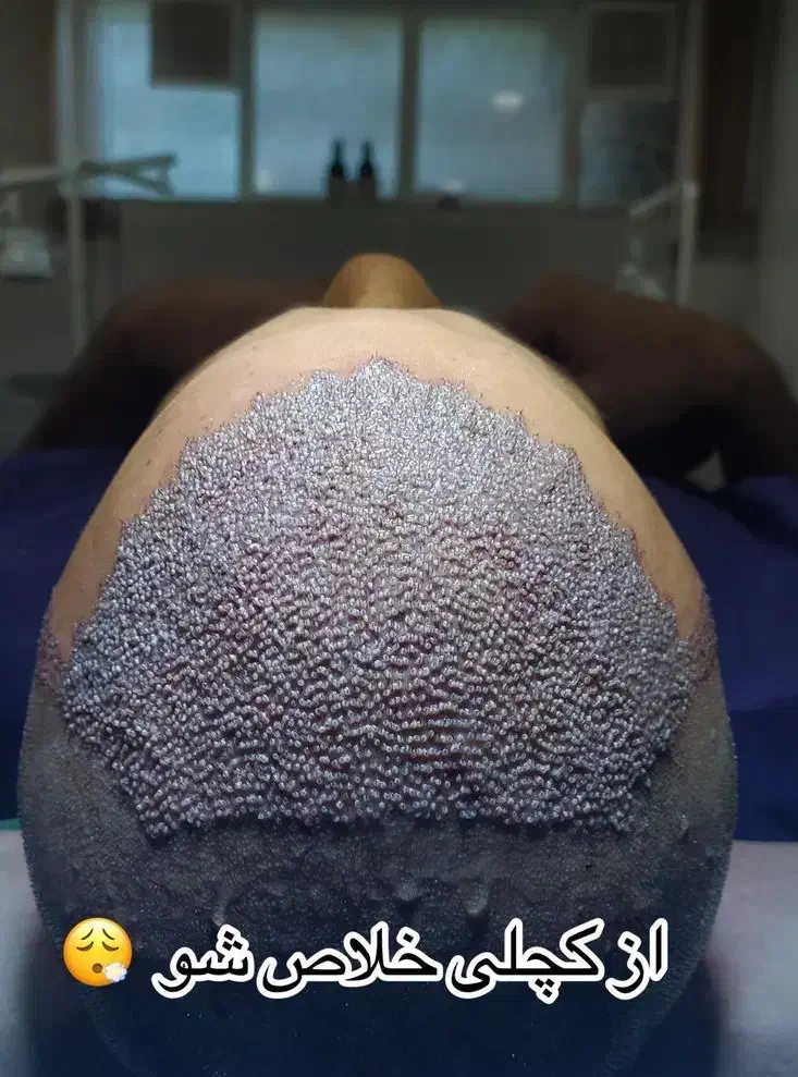 کاشت مو تارِنو|خدمات آرایشگری و زیبایی|خرم‌آباد, |دیوار