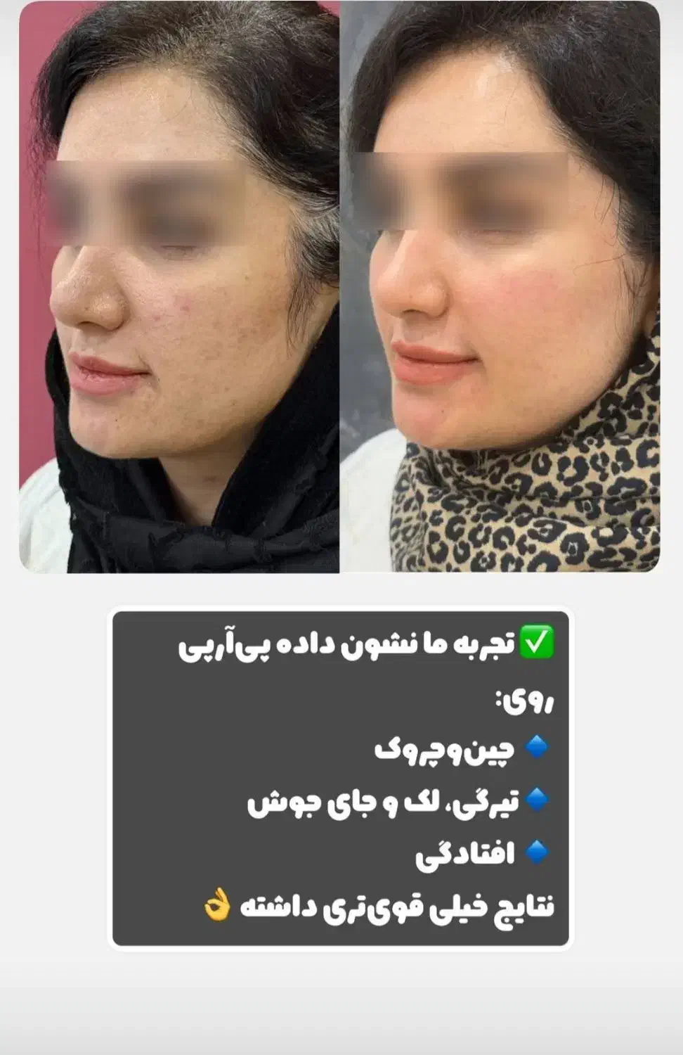 تزریقات زیبایی وجوانسازوفیلرها باتخفیف ویژه|خدمات آرایشگری و زیبایی|دوگنبدان, |دیوار