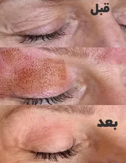 کک و مک،پلاسما،خالبرداری،جوانسازی|خدمات آرایشگری و زیبایی|شیراز, ستارخان|دیوار