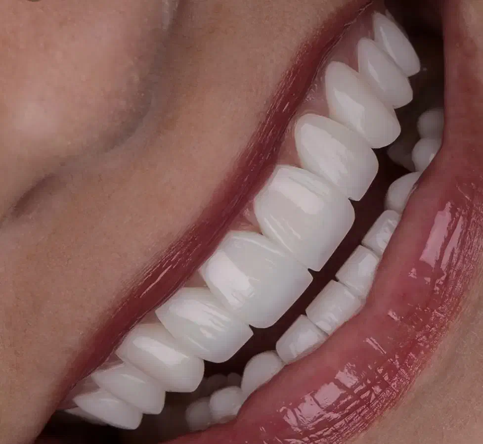 کامپوزیت دندان فقط قیمت مواد فرصت طلایی|خدمات آرایشگری و زیبایی|رشت, گلسار|دیوار