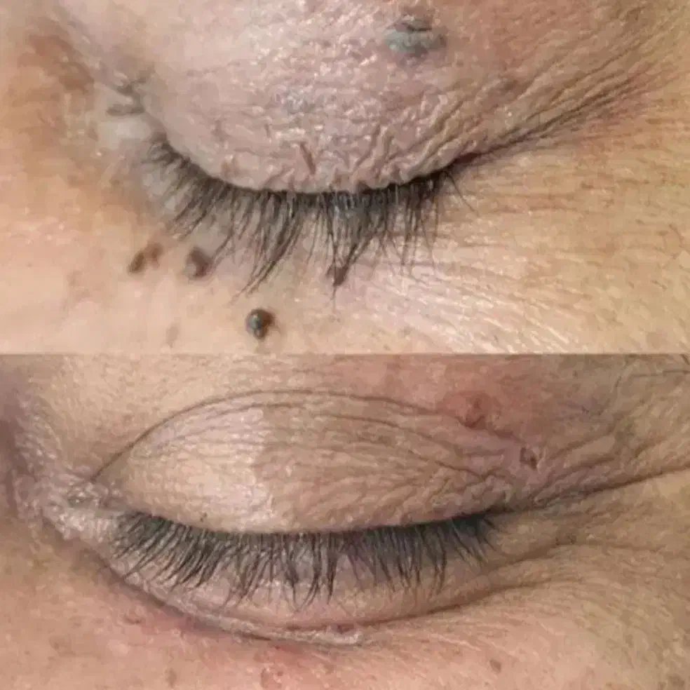 برداشتن خال.زگیل تناسلی.جای زخم و بخیه. میخچه|خدمات آرایشگری و زیبایی|کرمانشاه, |دیوار