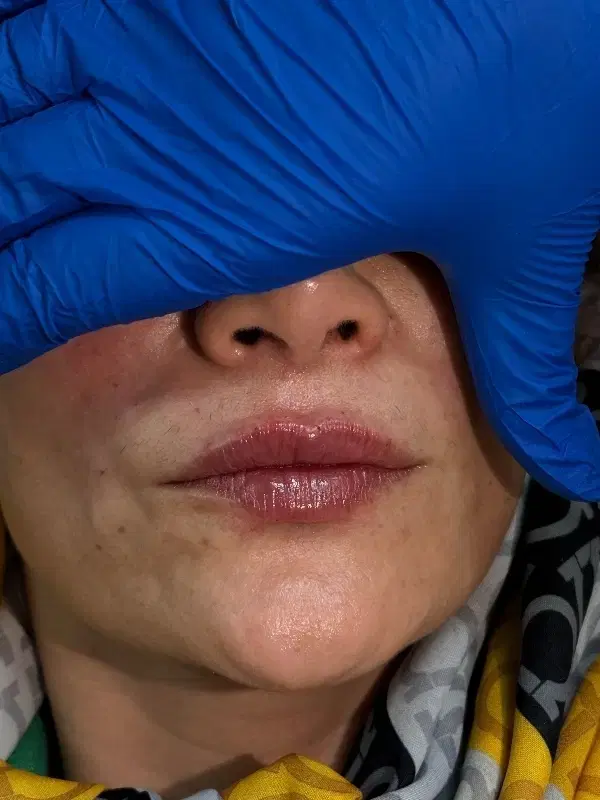 جشنواره تخفیف تزریق ژل لب و فیلرر مزو جوانساز|خدمات زیبایی و سلامت|تهران, شهرک ولیعصر شمالی|دیوار