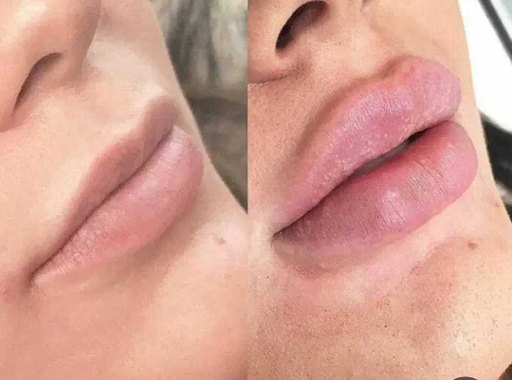 ژل و بوتاکس مزو ژل مزو تخفیفات 50 درصدی|خدمات آرایشگری و زیبایی|مشهد, فلسطین|دیوار