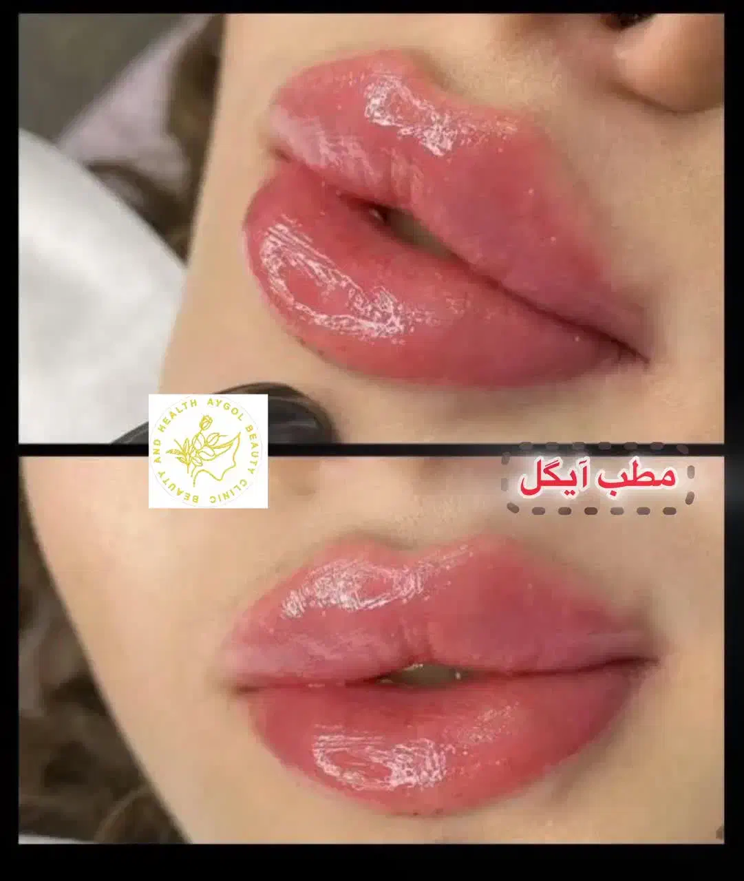 تزریق ژل وفیلر لب و گونه و چانه و..(جشنواره)درمطب|خدمات آرایشگری و زیبایی|اصفهان, ملکشهر|دیوار