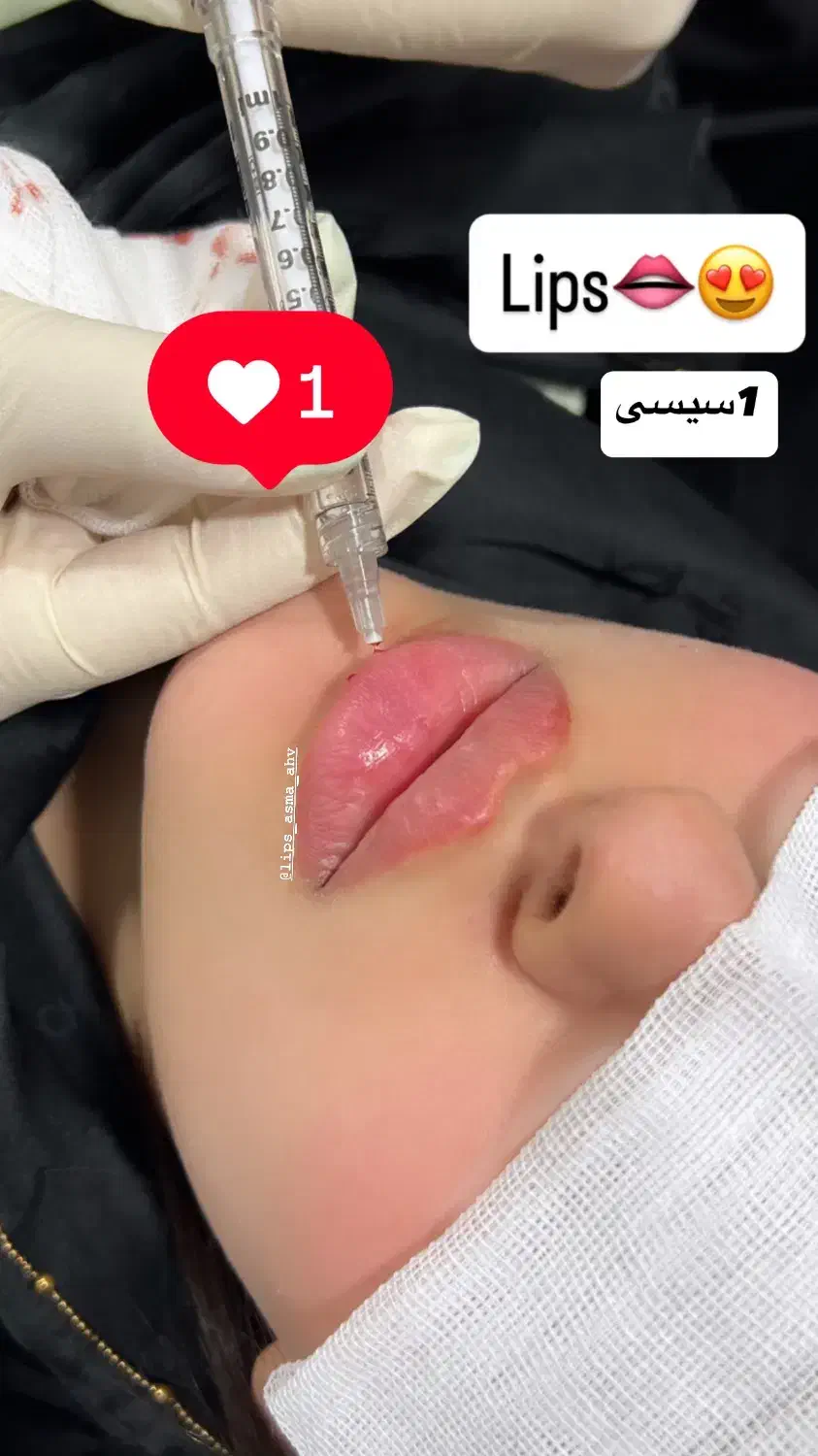 ژل وبوتاکس|خدمات آرایشگری و زیبایی|اهواز, کمپلو شمالی|دیوار