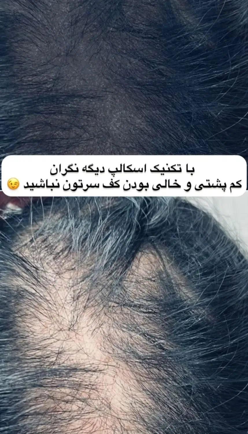 مدل برای موهای کم پشت خانم تکنیک میکرو اسکالپ|خدمات آرایشگری و زیبایی|لاهیجان, قیام|دیوار