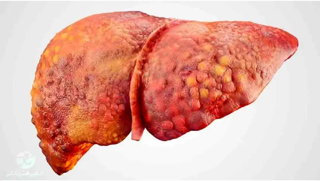 درمان کبد چرب با سونو رایگان گیاهان خوراکی|آرایشی، بهداشتی، درمانی|سمنان, |دیوار