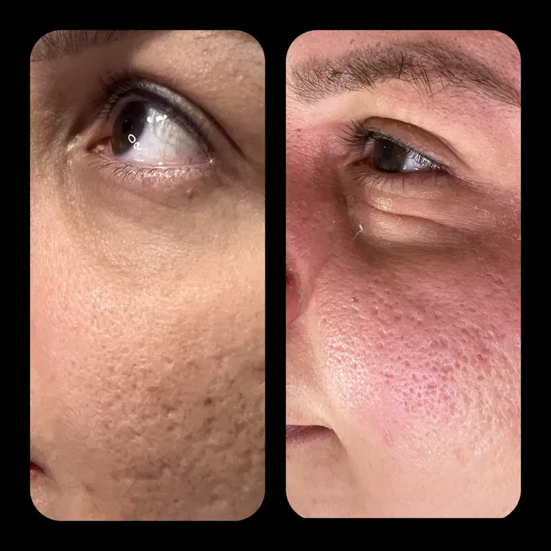 تزریق ژل و بوتاکس و چربی صورت توسط پزشک|خدمات آرایشگری و زیبایی|محمودآباد, |دیوار